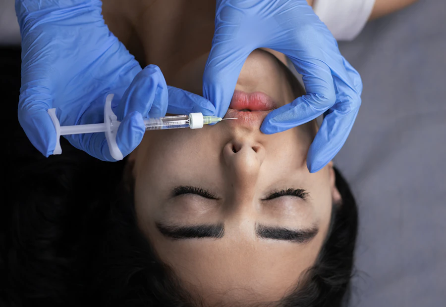 A practitioner placing lip filler with a fine syringe