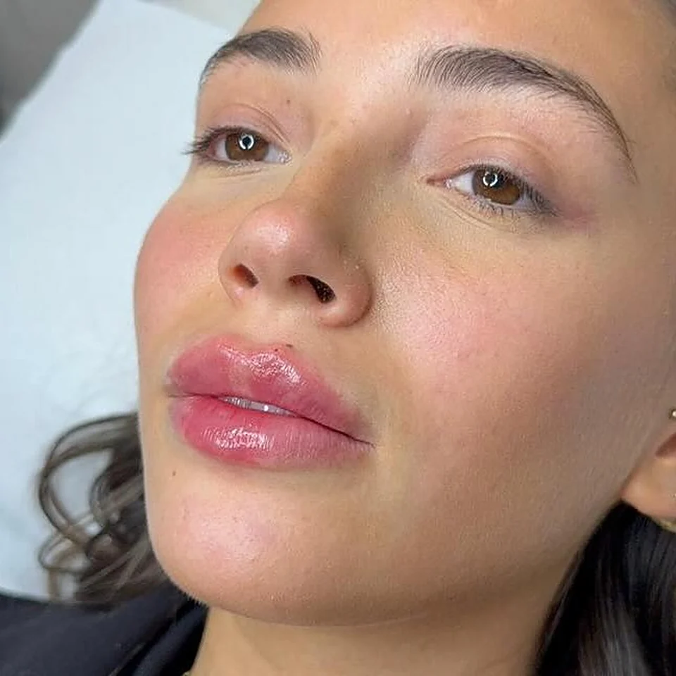 A woman with softly defined, glossy lips after a lip filler treatment at the clinic